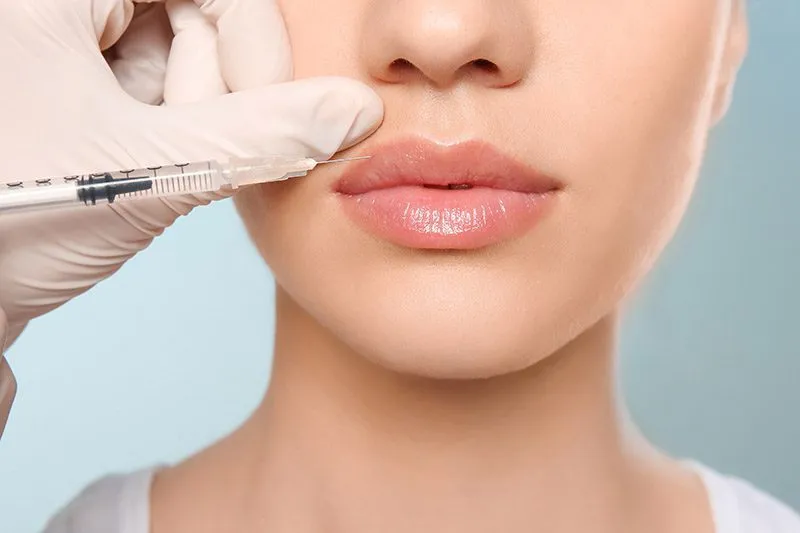 Dermal filler treatment for cheek and lip enhancement